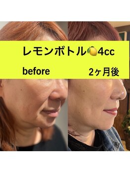 L’la citta【パーソナルカラー/毛穴洗浄/まつげパーマ/ヘッドスパ】/ララチッタでレモンボトル