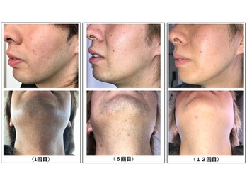 ココネローズ 福津サロン(Cocone Rose)の写真/【青ヒゲ卒業】完全個室＆都度払いOK◎メンズ脱毛初心者歓迎♪