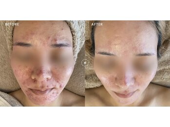 テンニック(10nick)の写真/【肌悩み徹底相談】エステが初めての方でも大歓迎♪肌質に合わせたオーダーメイド施術で"本気の肌改善"。