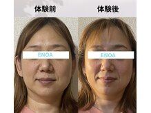 エノア(ENOA)の雰囲気（小顔コルギ×レッドショット１回フェイスラインの引上がり◎）