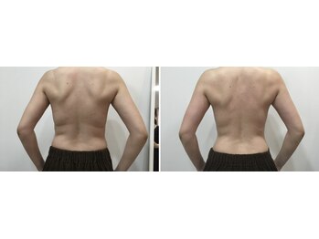 トータルビューティーサロン ナーズ(NAZ)/ハイパーナイフ