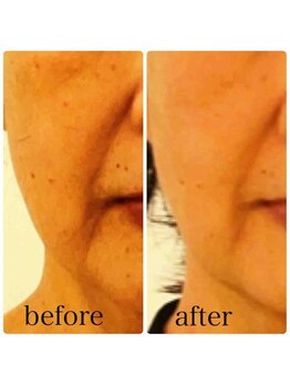 ブランシェ 野々市店 × 椿/シワ・たるみケア　お客様