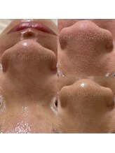 オフオルファヴォリ(OF Olu:Favori)/【韓国式３D毛穴洗浄】