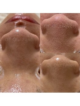 オフオルファヴォリ(OF Olu:Favori)/【韓国式3D毛穴洗浄】