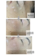 メリナ(Melina)/HITOYURAIエクソソーム導入