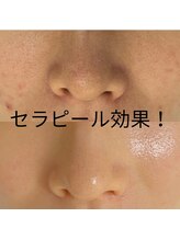 ポリー(Polly)/セラピール効果！/before&after