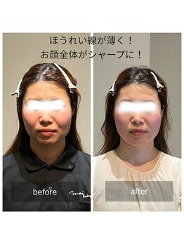ロッタ エクリュ(Lotta ecru+)/小顔矯正ビフォーアフター