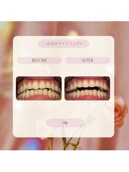 プラスビーセルフ(+b self)/ホワイトニングビフォーアフター