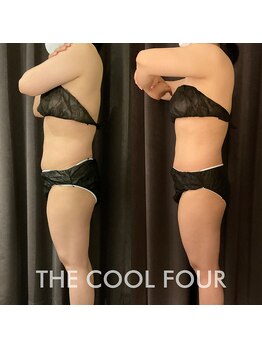 クライオ360(Cryo360)/脂肪冷却ビフォーアフター