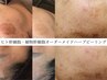 【最強肌質改善】ハーブピーリング【剥離無】天然×ヒト幹＋次世代ダ - マ