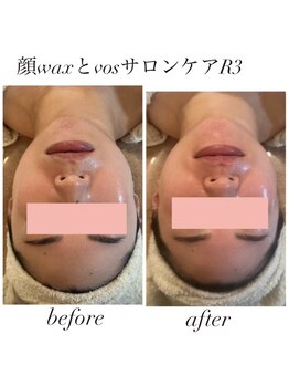 ソラ 六本松店(SORA)/お顔のWax脱毛とVOSサロンケア