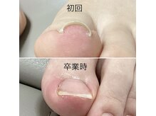 改善 根本 恵比寿院の雰囲気(巻き爪を改善♪【B/Sスパンゲ法】で痛みを抑えて巻き爪矯正◎)