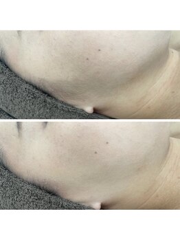 カルディエ(Cardie)/パーツ脱毛