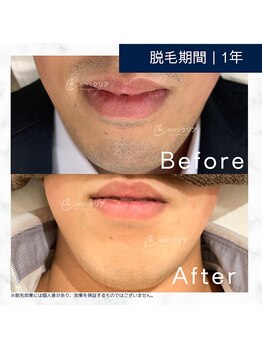 メンズクリア エルパプラス福井店/【メンズクリア】お客様の施術例