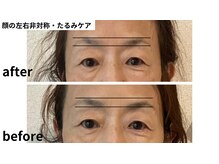 柚香鍼灸院/美容鍼灸ビフォーアフター