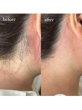 シャイニー 南堀江(SHINY)/【うなじWAX脱毛】