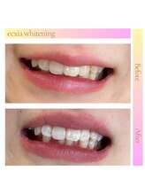 エクシアホワイト 宮崎花ヶ島店/ホワイトニングビフォーアフター