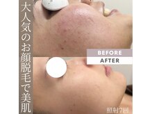モアトゥインクル 福山神辺店(MORE twinkle)の雰囲気（《Instagram⇒@moretwinkle_kannabe》症例載せています！#顔脱毛）
