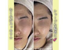 ハニエル(Haniel)/カーボキシー症例