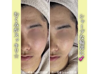 ハニエル(Haniel)/カーボキシー症例