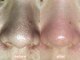しらゆき 名古屋黒川の写真/《毛穴レスの透明感のある素肌へ》エンビロン*ピーリングでお肌悩みを根本改善！毛穴・ニキビ・くすみに♪