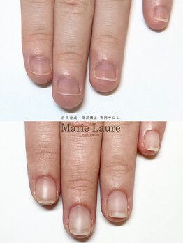 マリーロール 梅田店(Marie Laure)/自爪育成/深爪矯正/ネイルケア