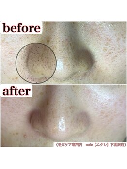 エクレ 下北沢店(ecle)/下北沢で黒ずみ解消！初回¥13000