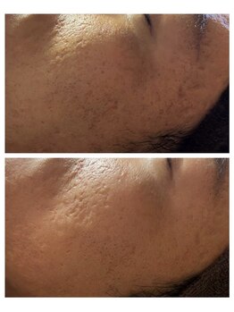 ルヴィショップ 沖縄(REVI SHOP)/剥けるハーブピーリング