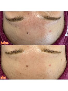 シープ(Sheep)/【ハーブピーリング】¥13800