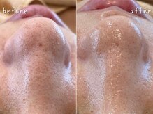 エヌエースキン センター北店(NA skin)/ハーブピーリング｜毛穴洗浄