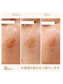 肌イズム 守谷店(肌ism)/40代女性のシミケア成功例!