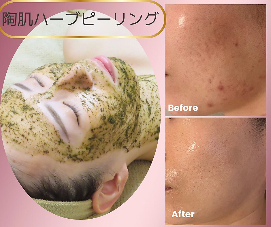 ハーブピーリングbeauty page1 先日ホワイトハーブピーリングをお手入れしたスタッフのビフォー
