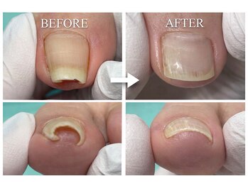 巻き爪補正店 金山店/巻き爪(初回と5回目）