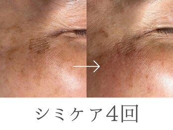 レイミー(reimee)/【シミケア4回】Before/ After