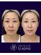 サロン ド ナース ユー ソナ(salon de nurse U.sona)の写真/【老け顔卒業！】医療提携の高周波×ヒアルリッチで目元/口元の小ジワ改善！高濃度幹細胞で透明感UP◎