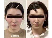 小顔22 ボルティ 赤坂支店(Bolty)/30代：施術10回