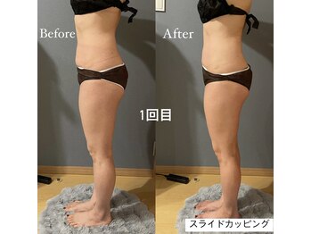 エマ(emma)/１度でもしっかり効果出ます