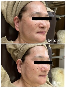 ジャスミン(Jasmin)/臍帯血幹細胞×NMN×AC-11