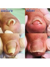 巻き爪補正店 湘南辻堂店/巻き爪・補正例