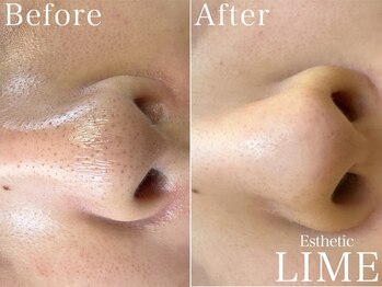 ライム 武庫之荘(LIME)/ハーブピーリング|毛穴洗浄