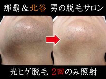 メンズディースタイル 首里店(Men's Dstyle)/ヒゲ脱毛2回でここまでスッキリ