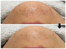 エフェクト 塚口店(effect)/Before After &nbsp;&nbsp;20代/1回目