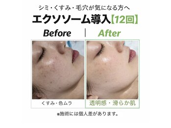 アプロ(Aphro)/若見えエクソソーム