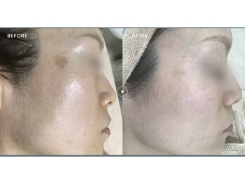 テンニック(10nick)の写真/【加古川駅から徒歩3分】加古川希少クリスティーナ正規取扱店！肌質改善/ニキビケア/ピーリング専門店
