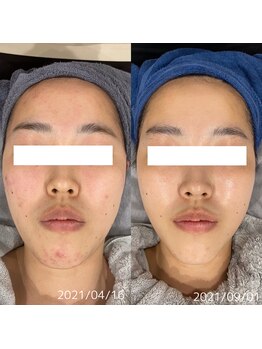 グラニット(Granit.)/フェイシャルBefore After