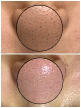 グリーン(green)/何をしてもダメだった毛穴悩みに