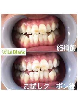 ルブラン 奈良店(Le Blanc)/目に見える着色汚れ