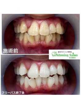 ホワイトニングサロン 名古屋駅店/【ホワイトニング施術例】