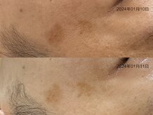 レイル(REIR)/ホームケア併用でシミケア◎