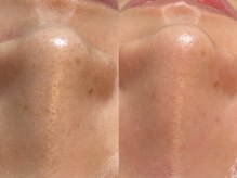 ヴィーヴ 京橋(vive)/【韓国式3D毛穴洗浄】